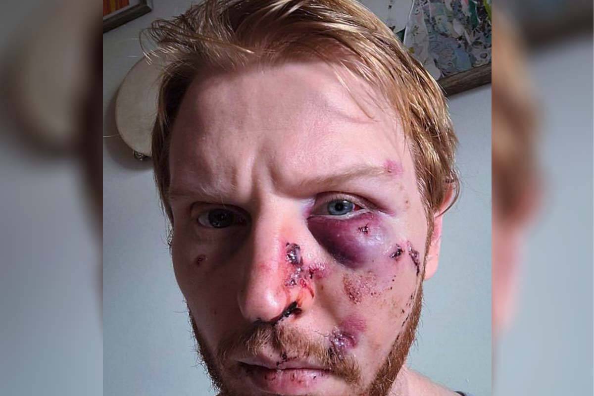 Jean Sebastien, a pizza cook at Dave & Mel’s Pizzeria in North Vancouver, was attacked while taking the garbage out at work on Nov. 19, 2022. Police are investigating multiple leads. (Photo credit: GoFundMe/Lower Lonsdale Random Attack Victim)
