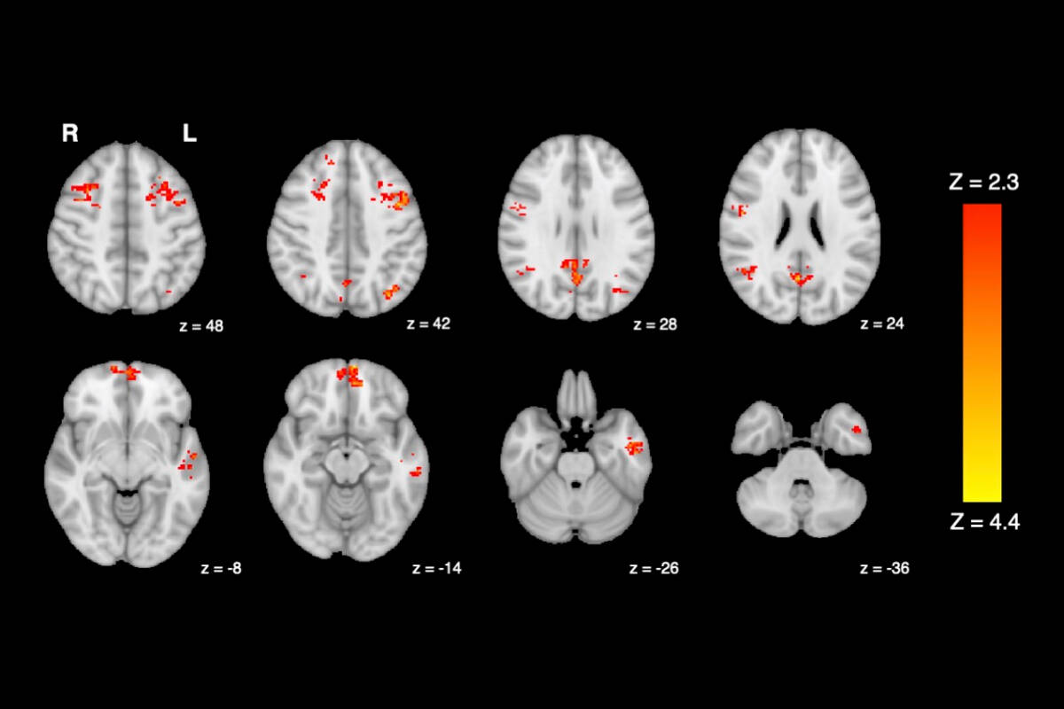 Functional magnetic resonance imaging (fMRI) shows decreased functional connectivity in the human brain after exposure to traffic pollution. (Courtesy UBC Faculty of Medicine)