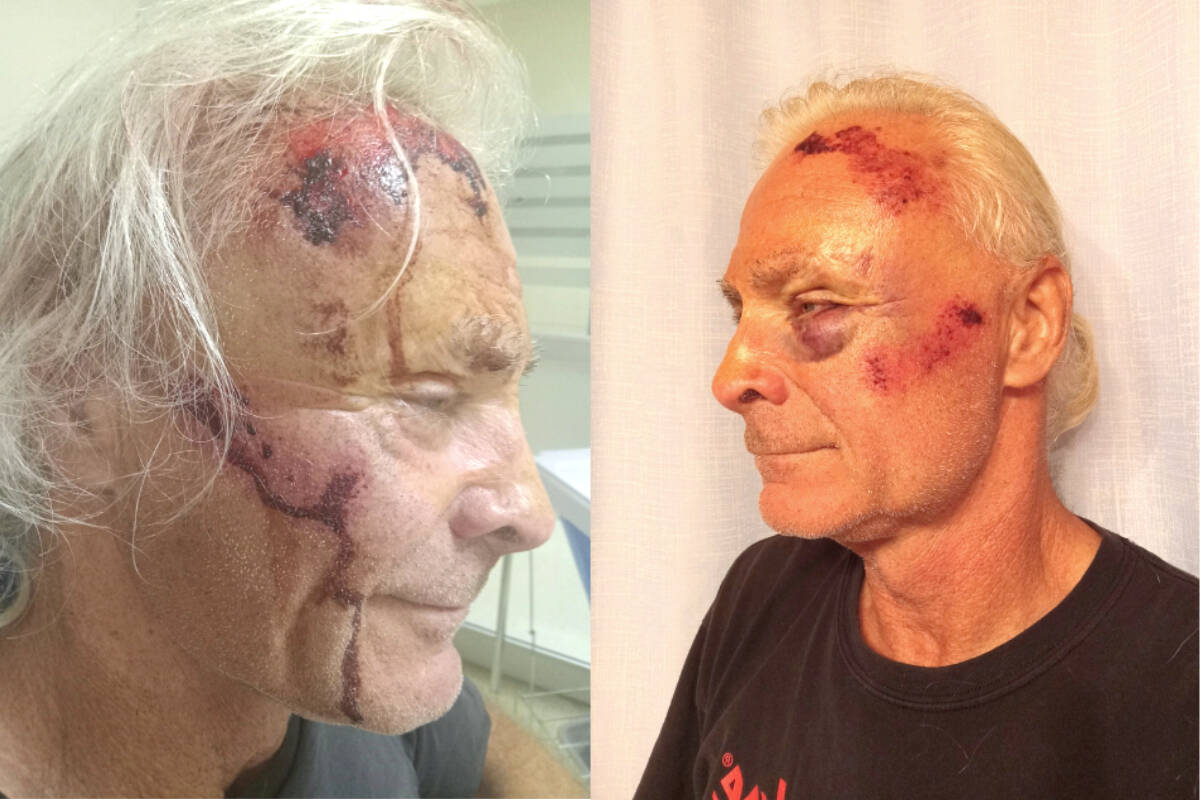 Korry Zepik said his head was pushed into the pavement while he was protesting against the anti-COVID crowd Saturday, Oct. 1, 2022 in Vernon. (Contributed)