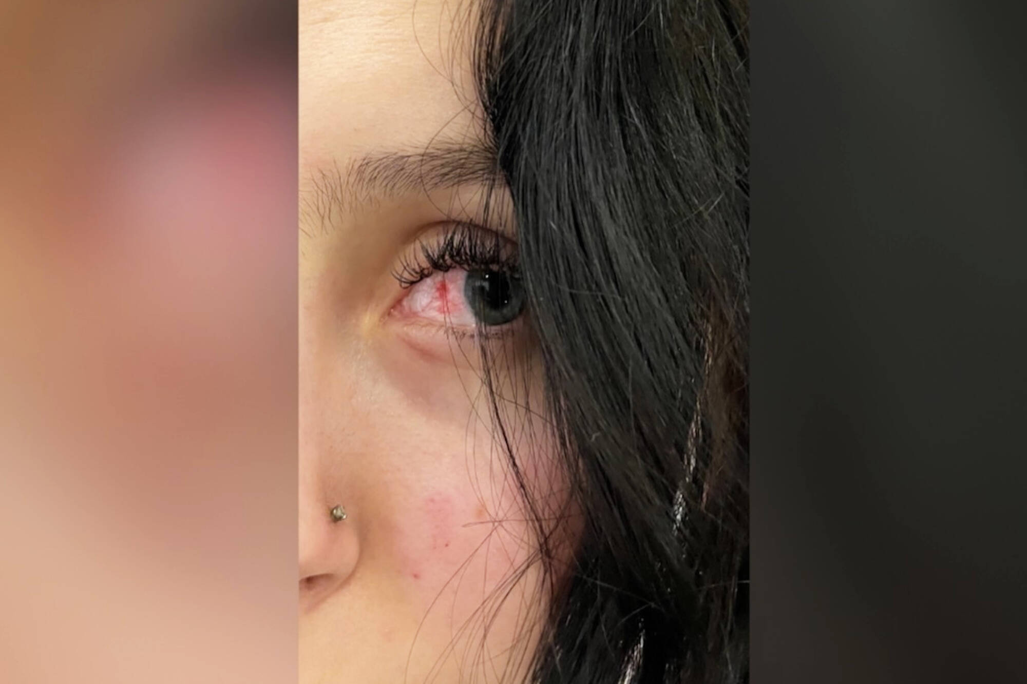 Jayda Koppel was expecting to develop a black eye, in addition to having a concussion and other injuries sustained after she and a friend were allegedly assaulted by an unknown driver in Silver Creek on Wednesday, March 8, 2023. (Jayda Koppel photo)