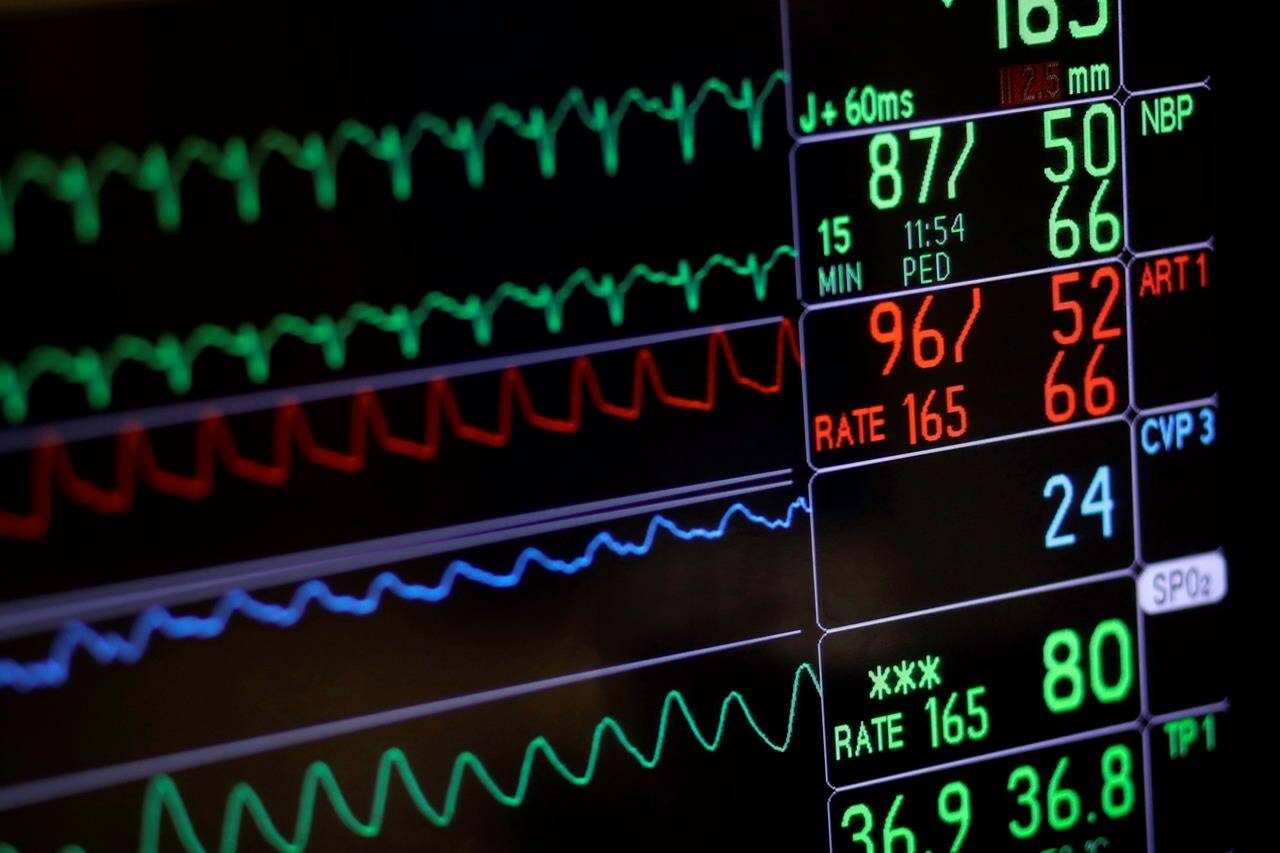 A screen displays a patient’s vital signs during open heart surgery at the University of Maryland Medical Center in Baltimore on Nov. 28, 2016. The senator who pushed for Canada’s assisted dying regime to include people whose only condition is a mental disorder says the debate about that policy is now over. THE CANADIAN PRESS/AP, Patrick Semansky